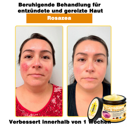 🔥Ourlyard® Bee Venom Pro Comprehensive Cream — 🔥80% OFF for a Limited Time🔥