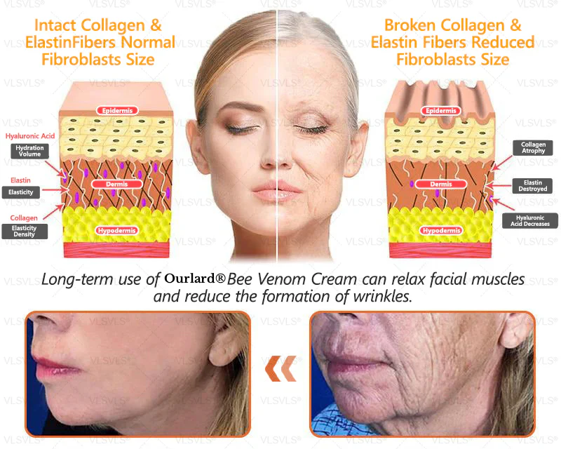 🔥Ourlyard® Bee Venom Pro Comprehensive Cream —🔥80% OFF for a Limited Time🔥