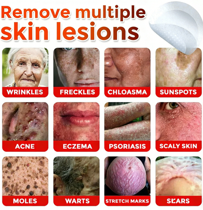 👨🏻‍⚕️🇩🇪 GFOUK® Microneedle Botanical Skin Tag Removal Patch ✅ Made in Germany