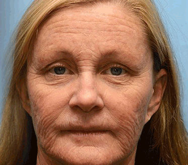 (🐝Made and Shipped from UK✅) Rekulo™ Botox Bee Venom Wrinkle Removal Cream- LAST DAY 70% OFF