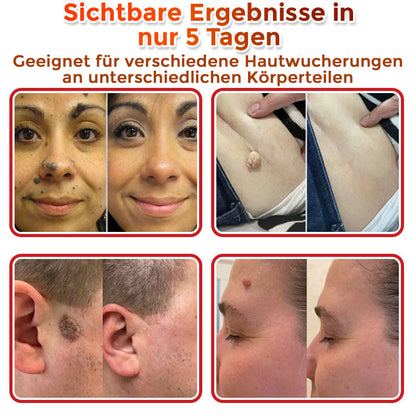 👨🏻‍⚕️🇩🇪 GFOUK® Mikronadel-Botanisches Hautanhängsel-Entfernungspflaster ✅ Hergestellt in Deutschland
