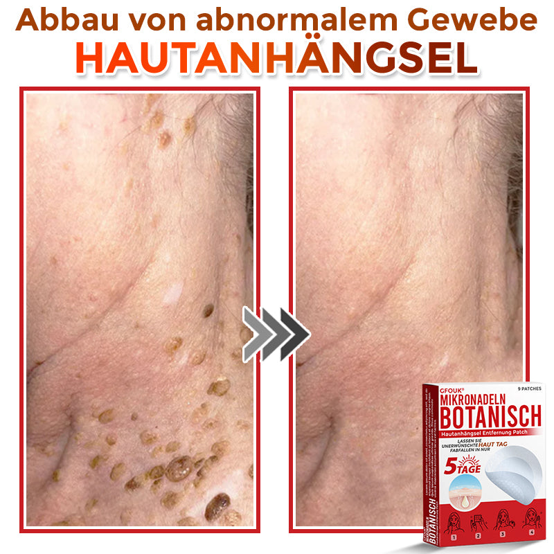 👨🏻‍⚕️🇩🇪 GFOUK® Mikronadel-Botanisches Hautanhängsel-Entfernungspflaster ✅ Hergestellt in Deutschland