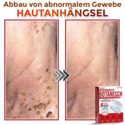 👨🏻‍⚕️🇩🇪 GFOUK® Mikronadel-Botanisches Hautanhängsel-Entfernungspflaster ✅ Hergestellt in Deutschland