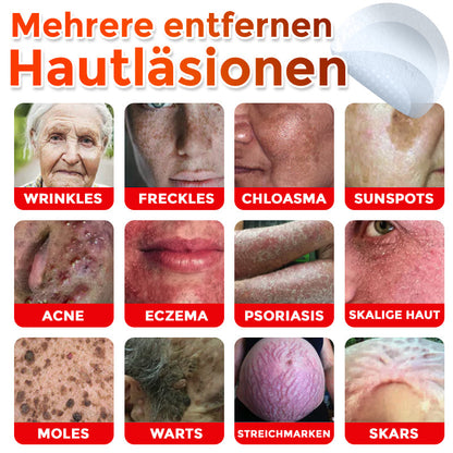 👨🏻‍⚕️🇩🇪 GFOUK® Mikronadel-Botanisches Hautanhängsel-Entfernungspflaster ✅ Hergestellt in Deutschland