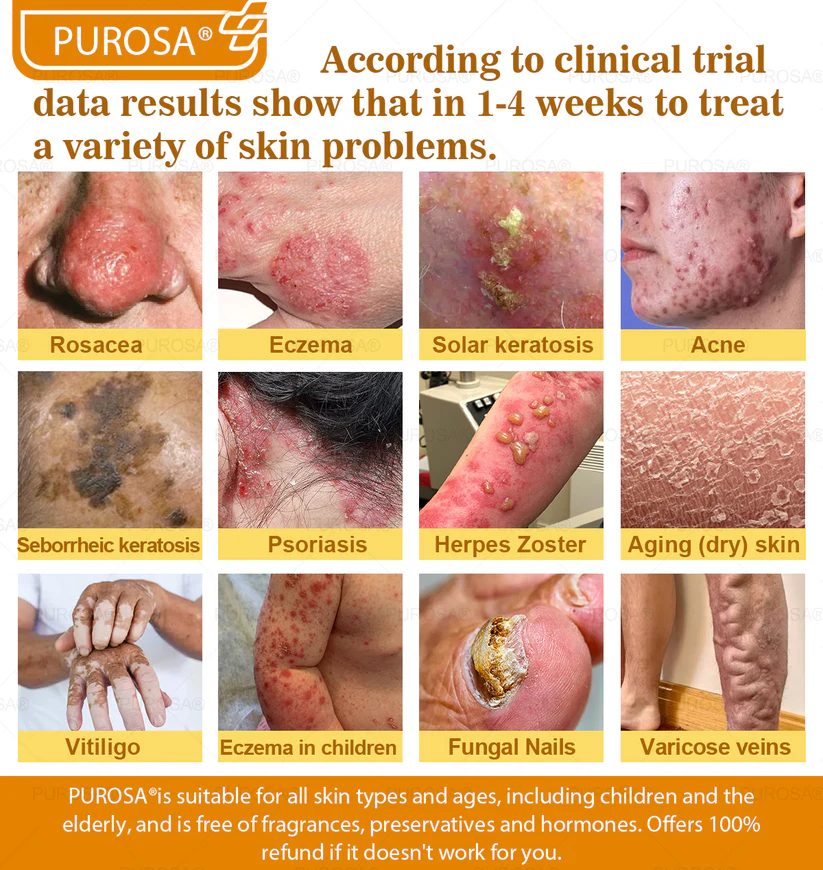 🐝PUROSA® Bee Venom Skin Treatment Cream, Anti-aging, Hydrating, Skin Repair, Even Tone, Acne and Dark Spot Treatment, Wart and Mole Removal, Psoriasis Relief