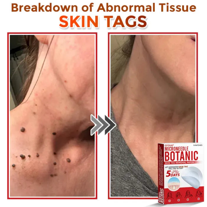 👨🏻‍⚕️🇩🇪 GFOUK® Microneedle Botanical Skin Tag Removal Patch ✅ Made in Germany